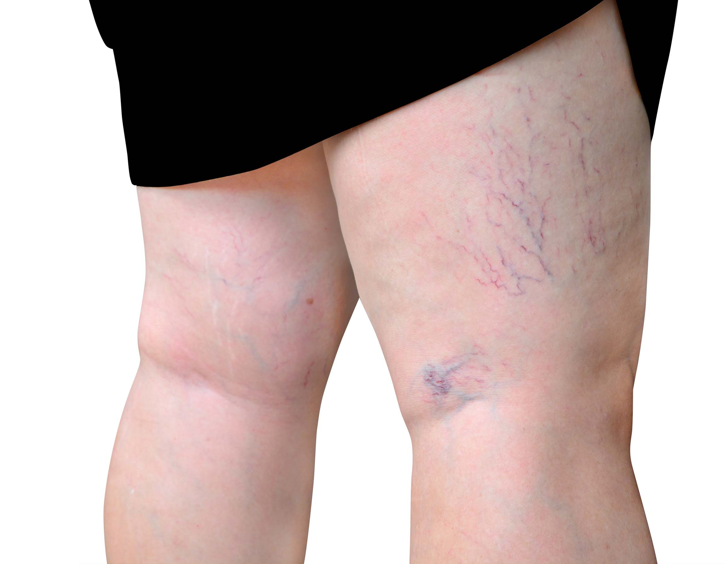 Doppler Ultrasound Diagnosis